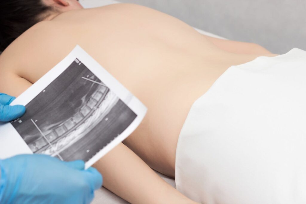 Csigolyaelcsúszás (spondylolisthesis)