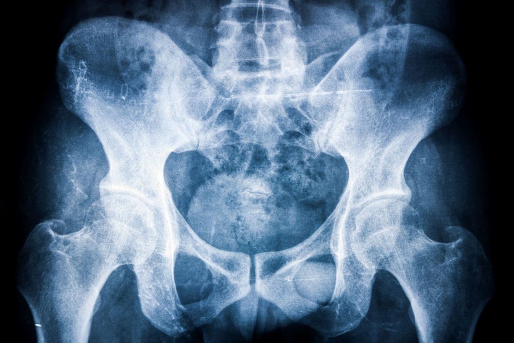 Ezek a leggyakoribb mozgásszervi betegségek 1 Bechterew-kór (spondylitis ankylopoetica)