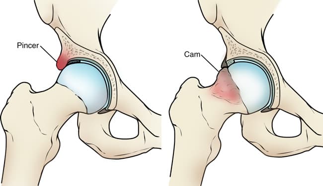 Femur acetabulum szindróma – a csípő ütközéses szindrómája 1 A csípőütközéses szindróma típusai