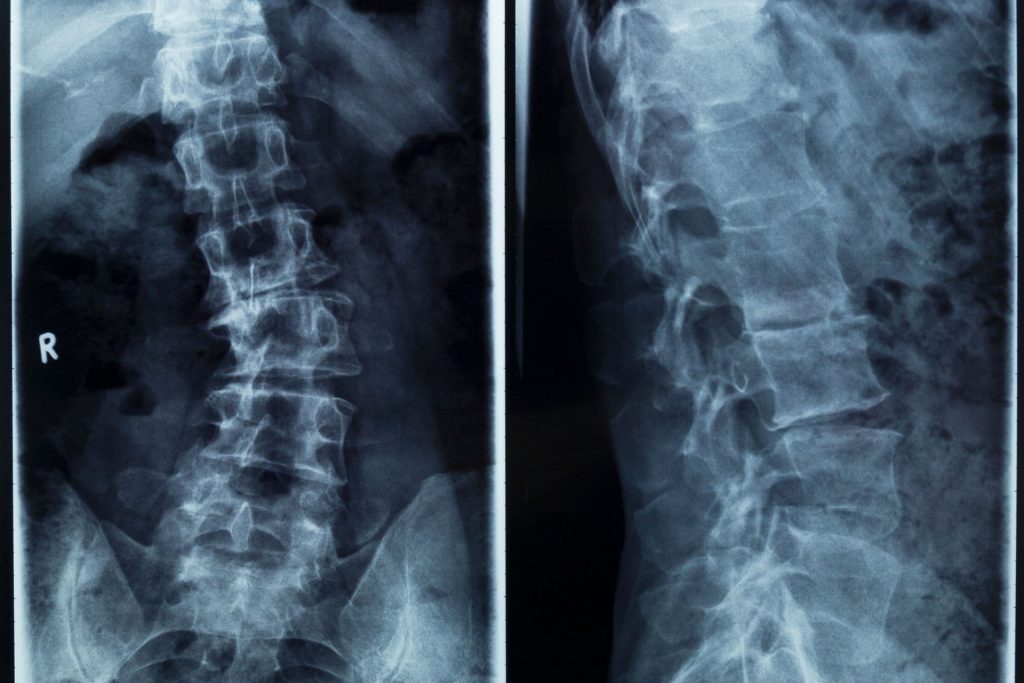 Borda fájdalom okai és kezelési módszerei a gyors felépülésért 3 Gerincferdülés (scoliosis)