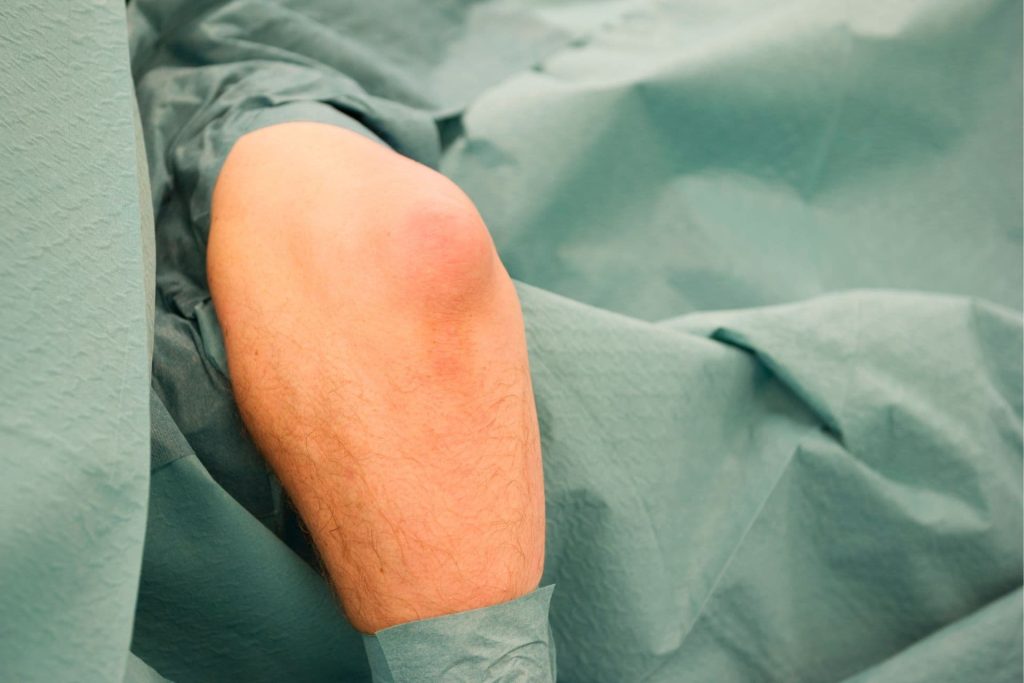 Ezek a könyökfájdalom gyakori okai és kezelési módjai 1 Könyök nyáktömlőgyulladás (olecranon bursitis)